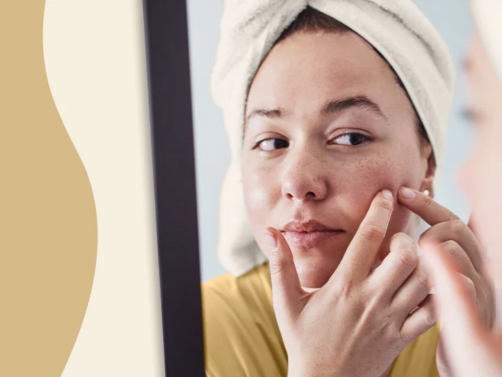 Why Treat Acne?